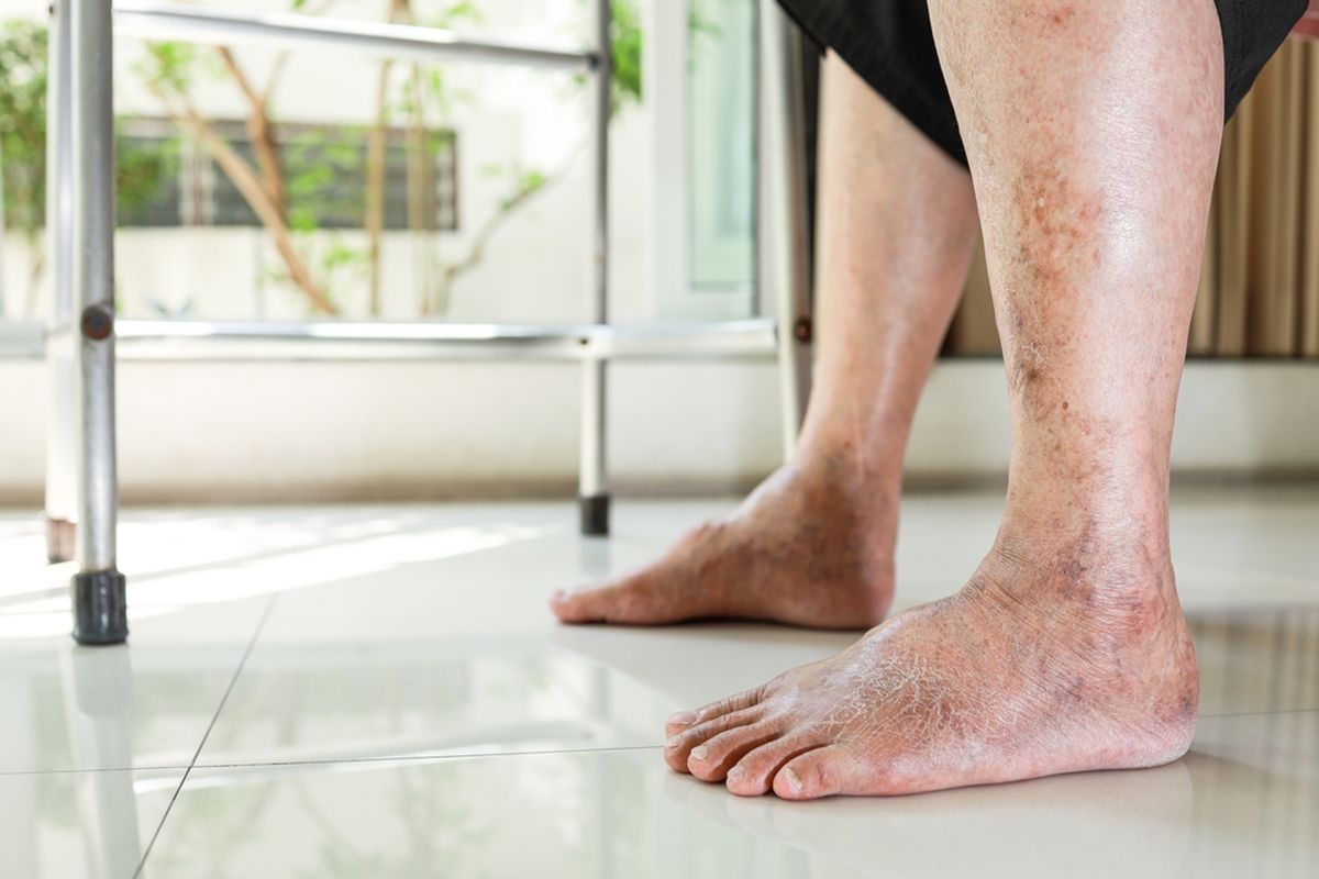 Gejala Awal Diabetes yang Sering Diabaikan Banyak Orang
